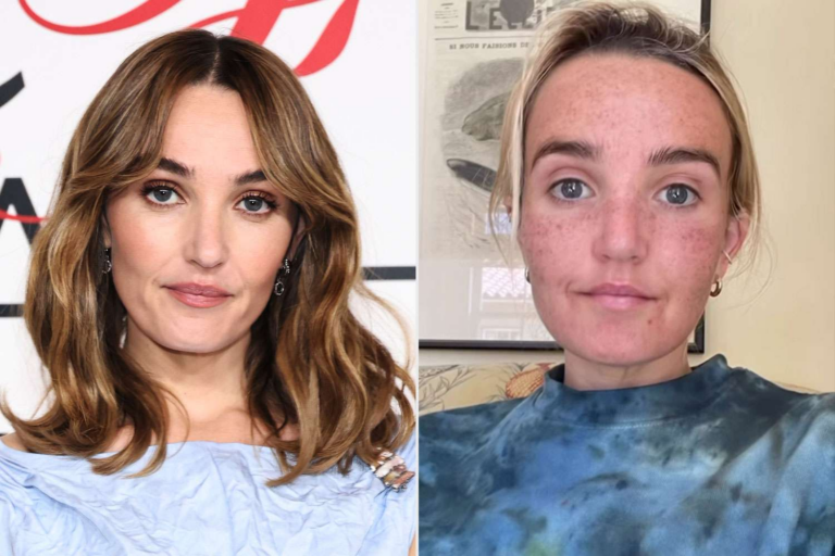 Chloe Fineman Shares ‘Botched’ iPhone Photos of Cosmetic Procedures